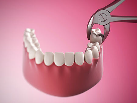 Extractions at West Park Dental