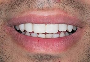 Smile Gallery - After