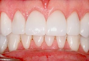 Smile Gallery - After
